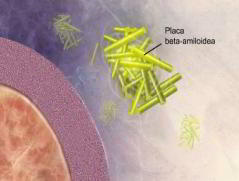 placa beta amiloide