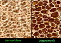 huesos con osteoporosis