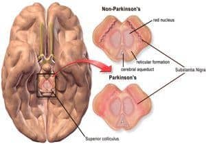 ilustración cerebro con parkinon