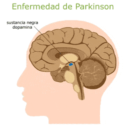 enfermedad de Parkinson