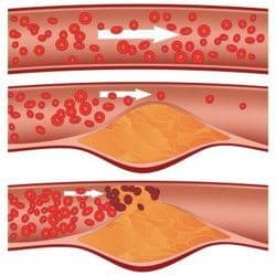 colesterol en una arteria - ateroesclerosis