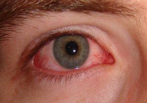 alergia ojos rojos