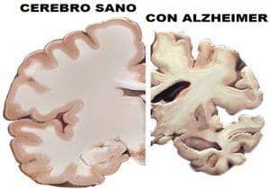 cerebro sano y con alzheimer
