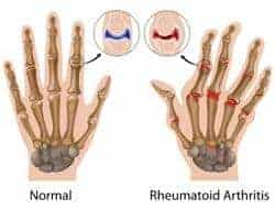 artritis reumatoide en articulaciones de los dedos de las manos