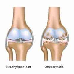 osteoartritis o artrosis de rodilla