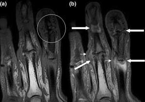 radiografía manos con artritis