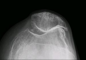 radiografía con artrosis