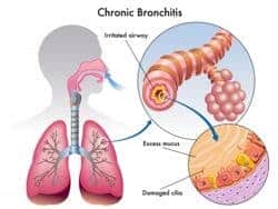 bronquitis crónica