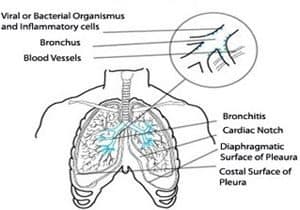 dibujo sobre causas de la bronquitis