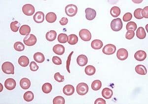 globulos rojos y anemia