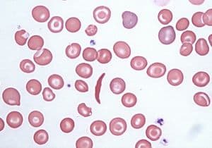 globulos rojos y anemia