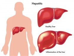 dibujo sobre hepatitis