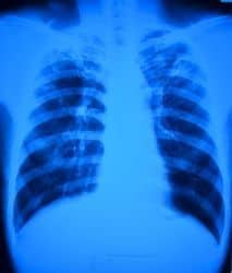radiografía de paciente con tuberculosis