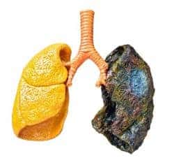 cancer de pulmón