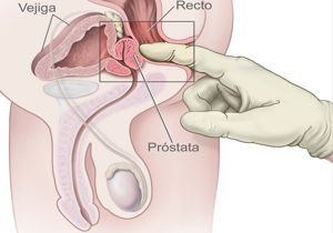 diagnostico cáncer de prostata