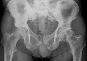 radiografía cancer de prostata