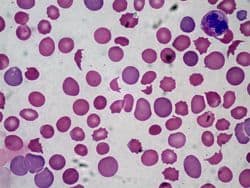 anemia y globulos rojos