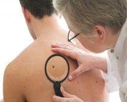 dermatologo analizando cáncer de piel