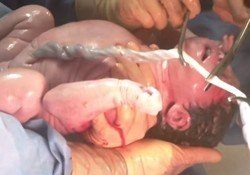 bebé y cordón umbilical