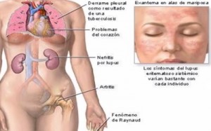 síntomas enfermedad de Lupus