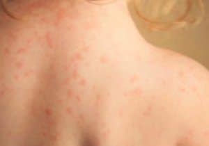 piel y alergia