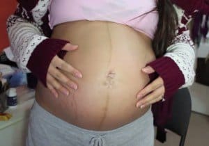 embarazada con estrías
