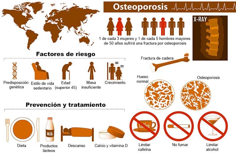 Infografía sobre la osteoporosis
