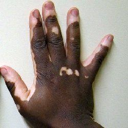 mano con vitiligo