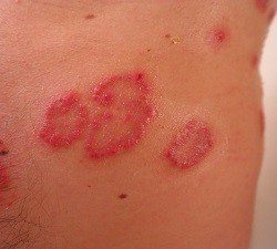 dermatitis en la piel