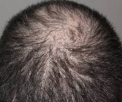 caída cabello - alopecia