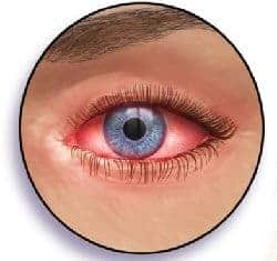 ojo con conjuntivitis