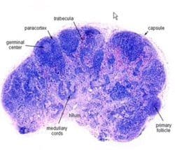 linfoma y estructura de ganglio