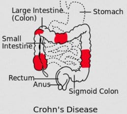 enfermedad crohn