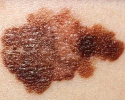 melanoma en la piel