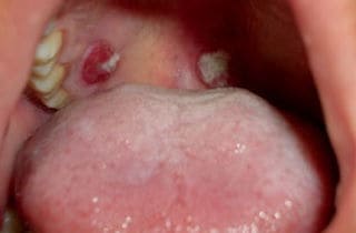 candidiasis orofaríngea - infección hongos en la boca