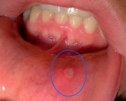estomatitis o úlcera bucal