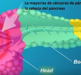 cáncer que aparece en la cabeza del páncreas