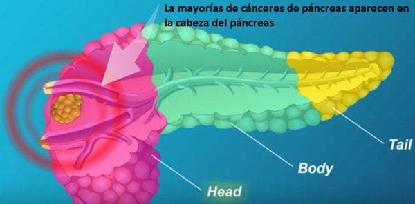 cáncer que aparece en la cabeza del páncreas