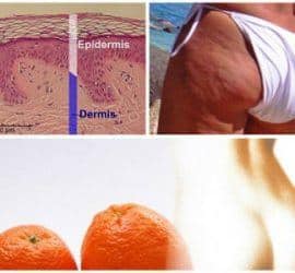 celulitis o piel de naranja
