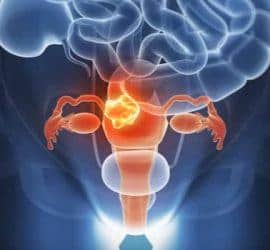 cáncer endometrio o endometrial