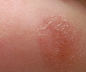 eczema en la piel