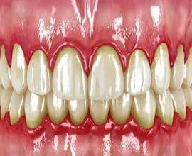 dientes con gingivitis