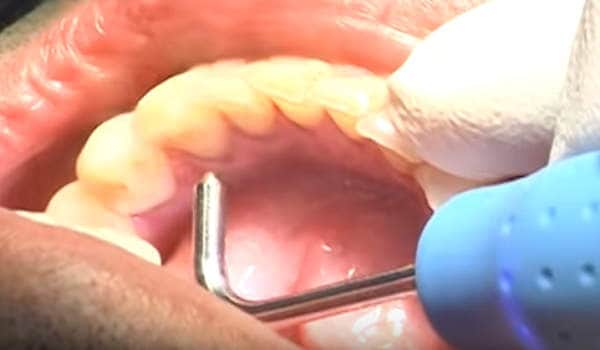 tratamiento del dentista para la gingivitis