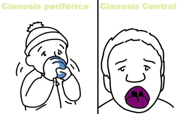 tipos de cianosis central y periférica