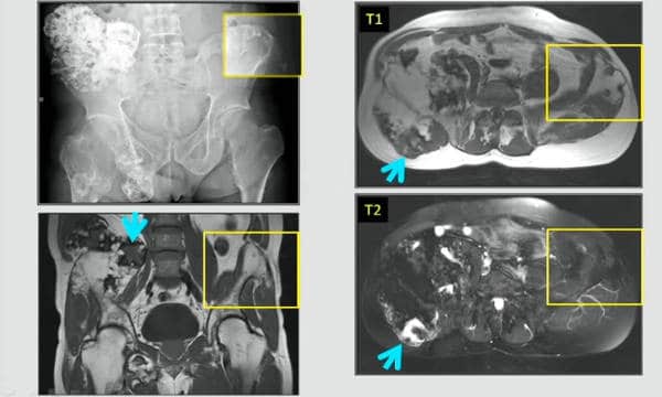 diagnóstico y radiografías de cáncer en los huesos